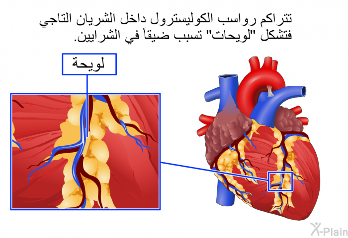 تتراكم رواسب الكوليسترول داخل الشريان التاجي فتشكل "لويحات" تسبب ضيقاً في الشرايين.