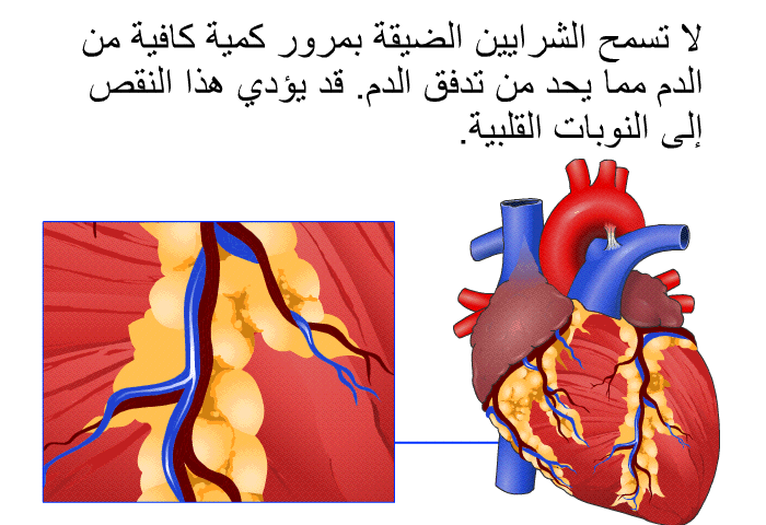 لا تسمح الشرايين الضيقة بمرور كمية كافية من الدم مما يحد من تدفق الدم. قد يؤدي هذا النقص إلى النوبات القلبية.
