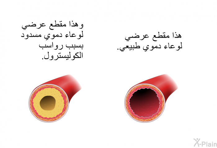 هذا مقطع عرضي لوعاء دموي طبيعي. 
 وهذا مقطع عرضي لوعاء دموي مسدود بسبب رواسب الكوليسترول.