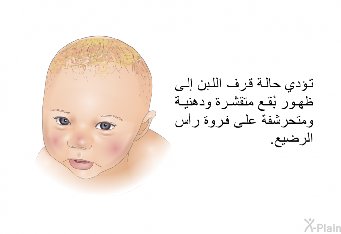 تؤدي حالة قرف اللبن إلى ظهور بُقع متقشرة ودهنية ومتحرشفة على فروة رأس الرضيع.