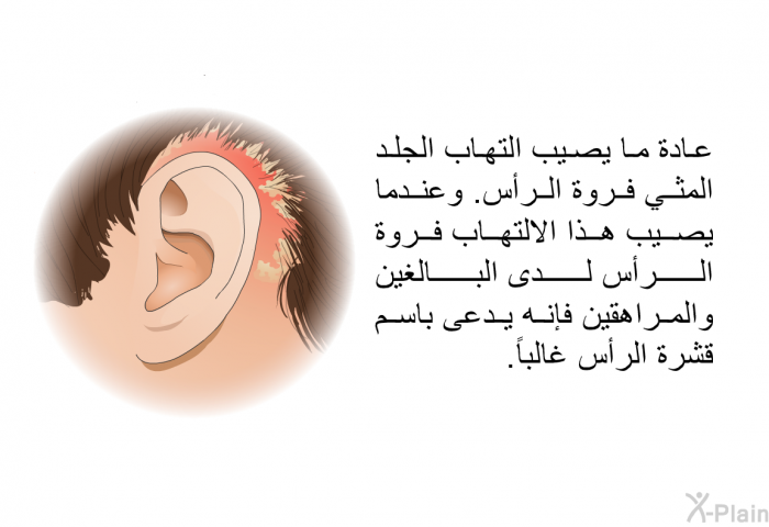 عادة ما يصيب التهاب الجلد المثي فروة الرأس. وعندما يصيب هذا الالتهاب فروة الرأس لدى البالغين والمراهقين فإنه يدعى باسم قشرة الرأس غالباً.