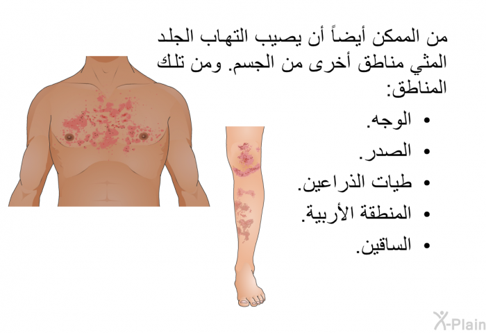 من الممكن أيضاً أن يصيب التهاب الجلد المثي مناطق أخرى من الجسم. ومن تلك المناطق:  الوجه. الصدر. طيات الذراعين. المنطقة الأربية. الساقين.