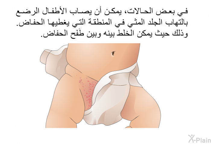 في بعض الحالات، يمكن أن يصاب الأطفال الرضع بالتهاب الجلد المثي في المنطقة التي يغطيها الحفاض. وذلك حيث يمكن الخلط بينه وبين طَفَح الحفاض.