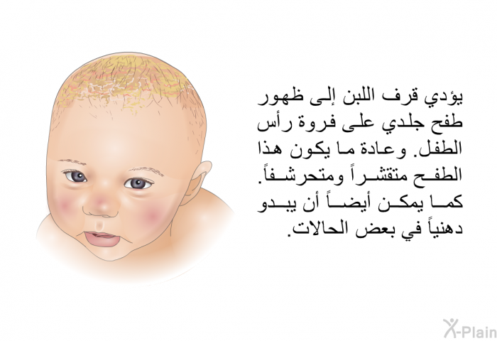 يؤدي قرف اللبن إلى ظهور طفح جلدي على فروة رأس الطفل. وعادة ما يكون هذا الطفح متقشراً ومتحرشفاً. كما يمكن أيضاً أن يبدو دهنياً في بعض الحالات.