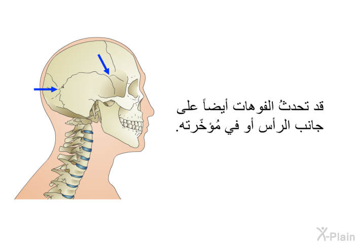 قد تحدثُ الفوهات أيضاً على جانب الرأس أو في مُؤخّرته.