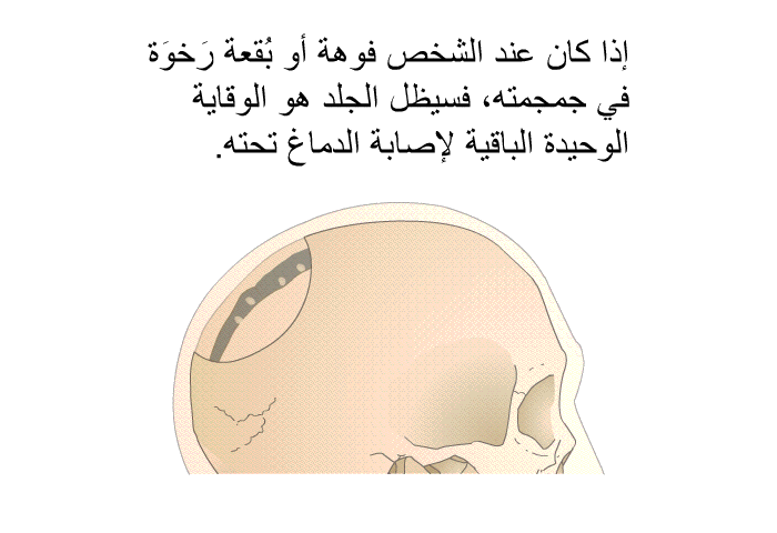 إذا كان عند الشخص فوهة أو بُقعة رَخوَة في جمجمته، فسيظل الجلد هو الوقاية الوحيدة الباقية لإصابة الدماغ تحته.