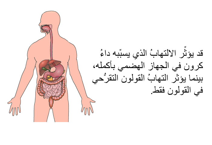 قد يؤثر الالتهابُ الذي يسببه داءُ كرون في الجهاز الهضمي بأكمله، بينما يؤثر التهابُ القولون التقرحي في القولون فقط.