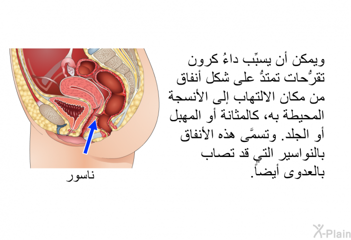 ويمكن أن يسبب داءُ كرون تقرحات تمتد على شكل أنفاق من مكان الالتهاب إلى الأنسجة المحيطة به، كالمثانة أو المهبل أو الجلد. وتسمى هذه الأنفاق بالنواسير التي قد تصاب بالعدوى أيضاً.