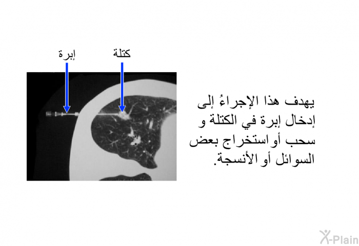 يهدف هذا الإجراءُ إلى إدخال إبرة في الكتلة وسحب أو استخراج بعض السوائل أو الأنسجة.