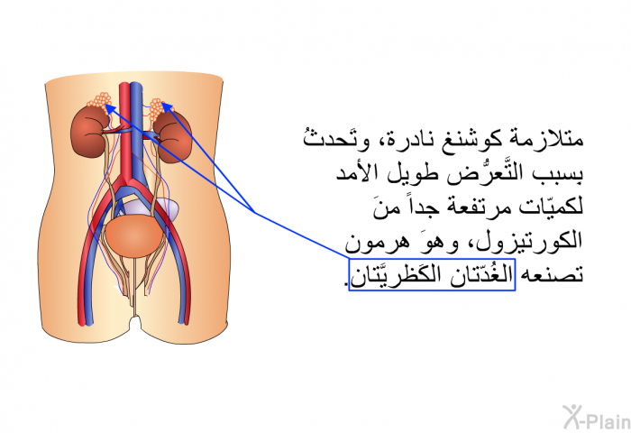 متلازمة كوشنغ نادرةٌ، وتَحدثُ بِسبب التَّعرُّض طويل الأمد لكميّات مرتفعة جداً منَ الكورتيزول، وهوَ هرمون تصنعه الغُدّتان الكَظريَّتان.