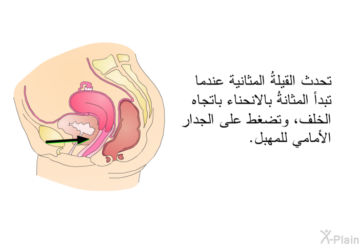 تحدث القيلةُ المثانية عندما تبدأ المثانةُ بالانحناء باتجاه الخلف، وتضغط على الجدار الأمامي للمهبل.