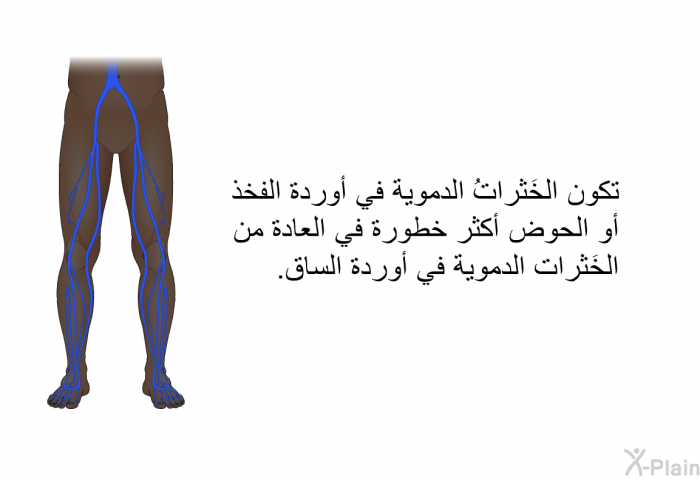 تكون الخَثراتُ الدموية في أوردة الفخذ أو الحوض أكثر خطورة في العادة من الخَثرات الدموية في أوردة الساق.