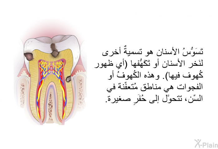 تَسَوُّسُ الأسنان هو تسميةٌ أخرى لنَخر الأسنان أو تَكَهُّفها (أي ظهور كُهوف فيها). وهذه الكُهوفُ أو الفجوات هي مناطق مُتعفِّنة في السِّن، تتحوَّل إلى حُفَرٍ صغيرة.