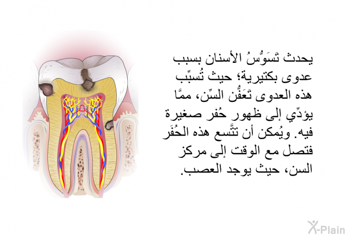 يحدث تَسَوُّسُ الأسنان بسبب عدوى بكتيرية؛ حيث تُسبِّب هذه العدوى تَعَفُّن السِّن، ممَّا يؤدِّي إلى ظهور حُفر صغيرة فيه. ويُمكن أن تتَّسع هذه الحُفَر فتصل مع الوقت إلى مركز السن، حيث يوجد العصب.