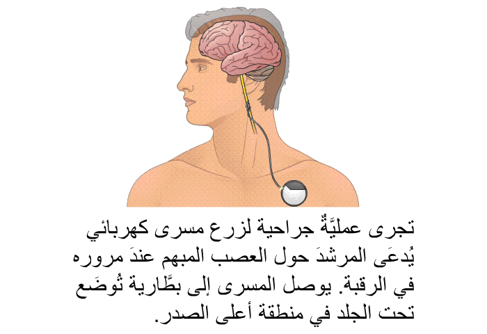 تجرى عمليَّةٌ جراحية لزرع مسرى كهربائي يُدعَى المرشدَ حول العصب المبهم عندَ مروره في الرقبة. يوصل المسرى إلى بطَّارية تُوضَع تحت الجلد في منطقة أعلى الصدر.