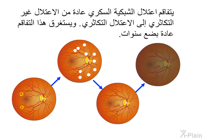 يتفاقم اعتلال الشبكية السكري عادة من الاعتلال غير التكاثري إلى الاعتلال التكاثري. ويستغرق هذا التفاقم عادة بضع سنوات.