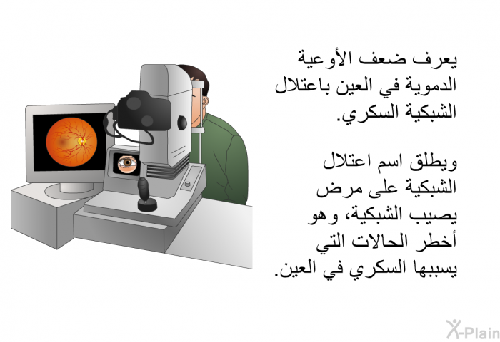 يعرف ضعف الأوعية الدموية في العين باعتلال الشبكية السكري. ويطلق اسم اعتلال الشبكية على مرض يصيب الشبكية، وهو أخطر الحالات التي يسببها السكري في العين.