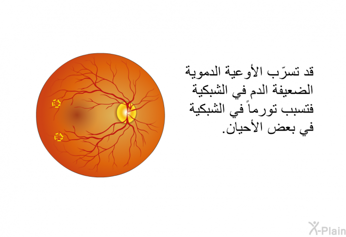 قد تتسرّب الأوعية الدموية الضعيفة الدم في الشبكية فتسبب تورماً في الشبكية في بعض الأحيان.