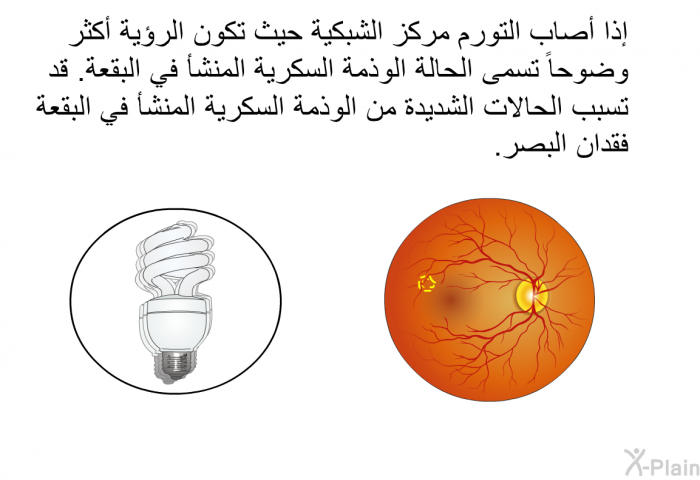 إذا أصاب التورم مركز الشبكية حيث تكون الرؤية أكثر وضوحا تسمى الحالة الوذمة السكرية المنشأ في البقعة. قد تسبب الحالات الشديدة من الوذمة السكرية المنشأ في البقعة فقدان البصر.