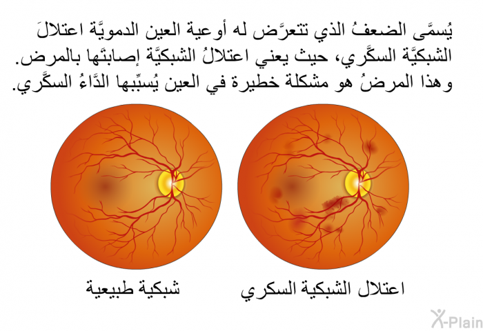 يُسمَّى الضعفُ الذي تتعرَّض له أوعية العين الدمويَّة اعتلالَ الشبكيَّة السكَّري، حيث يعني اعتلالُ الشبكيَّة إصابتَها بالمرض. وهذا المرضُ هو مشكلة خطيرة في العين يُسبِّبها الدَّاءُ السكَّري.