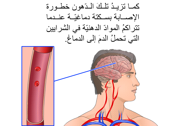 كما تزيدُ تلكَ الدّهون خطورة الإصابة بسكتة دماغيّة عندما تتراكمُ الموادّ الدهنيّة في الشرايين التي تحملُ الدمَ إلى الدماغ.