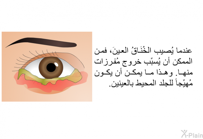 عندما يُصيب الخُنَاقُ العينَ، فمن الممكن أن يُسبِّب خروج مُفرزات منها. وهذا ما يمكن أن يكون مُهيِّجاً للجلد المحيط بالعينين.