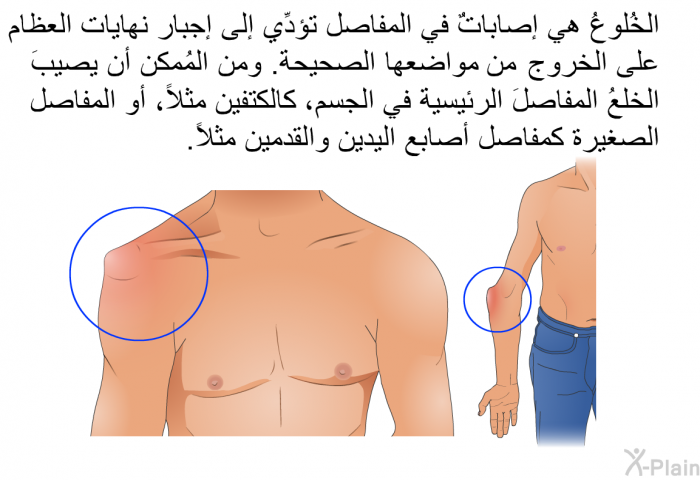 الخُلوعُ هي إصاباتٌ في المفاصل تؤدِّي إلى إجبار نهايات العظام على الخروج من مواضعها الصحيحة. ومن المُمكن أن يصيبَ الخلعُ المفاصلَ الرئيسية في الجسم، كالكتفين مثلاً، أو المفاصل الصغيرة كمفاصل أصابع اليدين والقدمين مثلاً.