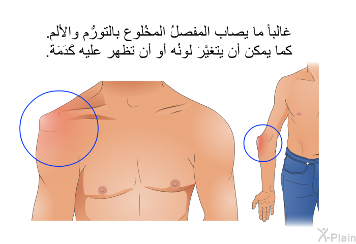 غالباً ما يصاب المفصلُ المخُلوع بالتورُّم والألم. كما يمكن أن يتغيَّرَ لونُه أو أن تظهر عليه كَدَمَة.