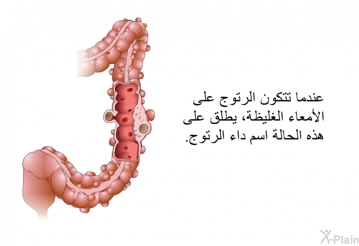عندما تتكون الرتوج على الأمعاء الغليظة، يطلق على هذه الحالة اسم داء الرتوج.