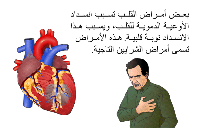 بعض أمراض القلب تسبب انسداد الأوعية الدموية للقلب، ويسبب هذا الانسداد نوبة قلبية. هذه الأمراض تسمى أمراض الشرايين التاجية.