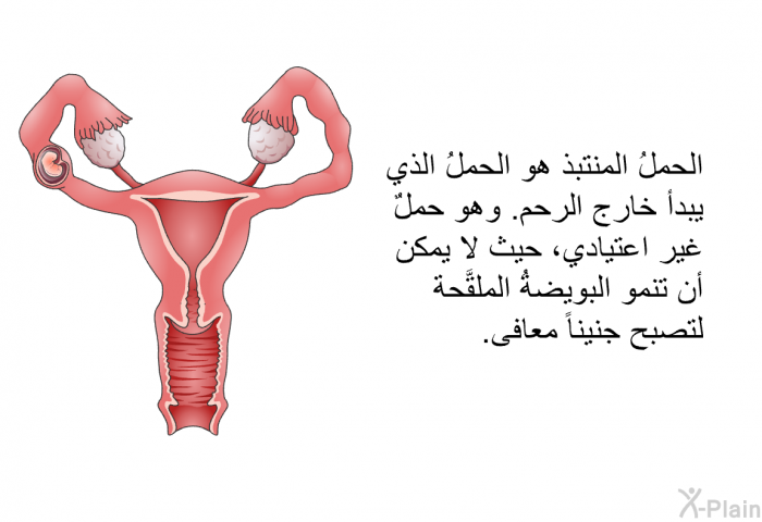الحملُ المنتبذ هو الحملُ الذي يبدأ خارج الرحم. وهو حملٌ غير اعتيادي، حيث لا يمكن أن تنمو البويضةُ الملقَّحة لتصبح جنيناً معافى.