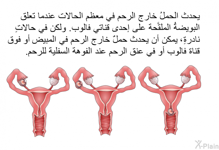 يحدث الحملُ خارج الرحم في معظم الحالات عندما تعلق البويضةُ الملقَّحة على إحدى قناتي فالوب. ولكن في حالاتٍ نادرةٍ، يمكن أن يحدث حملٌ خارج الرحم في المبيض أو فوق قناة فالوب أو في عنق الرحم عند الفوهة السفلية للرحم.