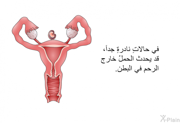 في حالاتٍ نادرةٍ جداً، قد يحدث الحملُ خارج الرحم في البطن.