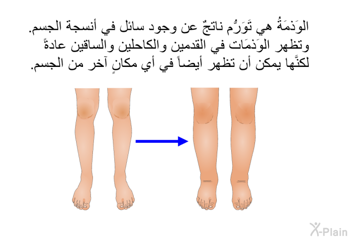 الوَذمَةُ هي تَوَرُّم ناتجٌ عن وجود سائل في أنسجة الجسم. وتظهر الوَذمَات في القدمين والكاحلين والساقين عادةً، لكنَّها يمكن أن تظهر أيضاً في أي مكانٍ آخر من الجسم.