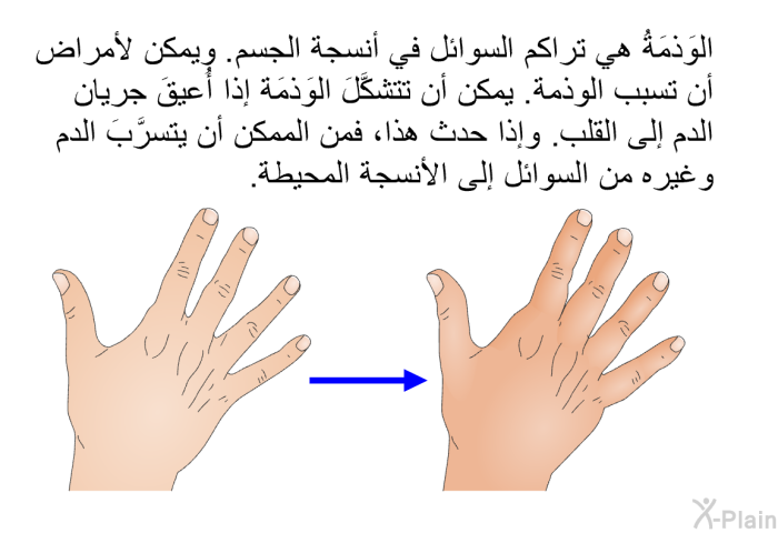 الوَذمَةُ هي تراكم السوائل في أنسجة الجسم. ويمكن لأمراض أن تسبب الوذمة. يمكن أن تتشكَّلَ الوَذمَة إذا أُعيقَ جريان الدم إلى القلب. وإذا حدث هذا، فمن الممكن أن يتسرَّبَ الدم وغيره من السوائل إلى الأنسجة المحيطة.