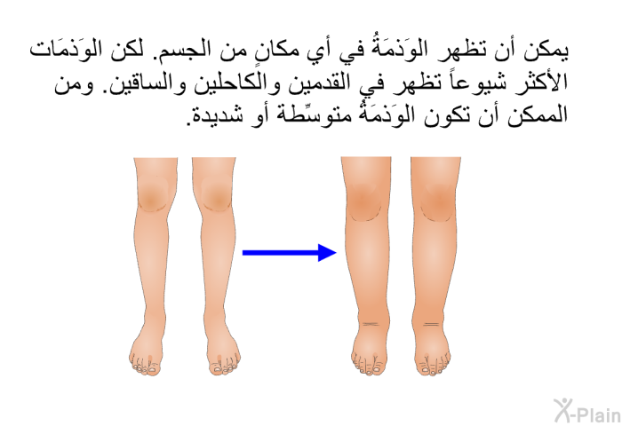 يمكن أن تظهر الوَذمَةُ في أي مكانٍ من الجسم. لكن الوَذمَات الأكثر شيوعاً تظهر في القدمين والكاحلين والساقين. ومن الممكن أن تكون الوَذمَةُ متوسِّطة أو شديدة.