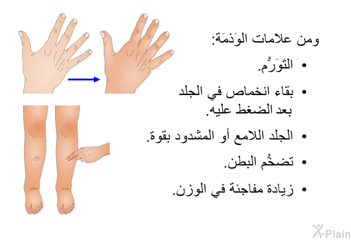 ومن علامات الوَذمَة:   التَوَرُّم.  بقاء انخماص في الجلد بعد الضغط عليه.  الجلد اللامع أو المشدود بقوة.  تضخُّم البطن.  زيادة مفاجئة في الوزن.