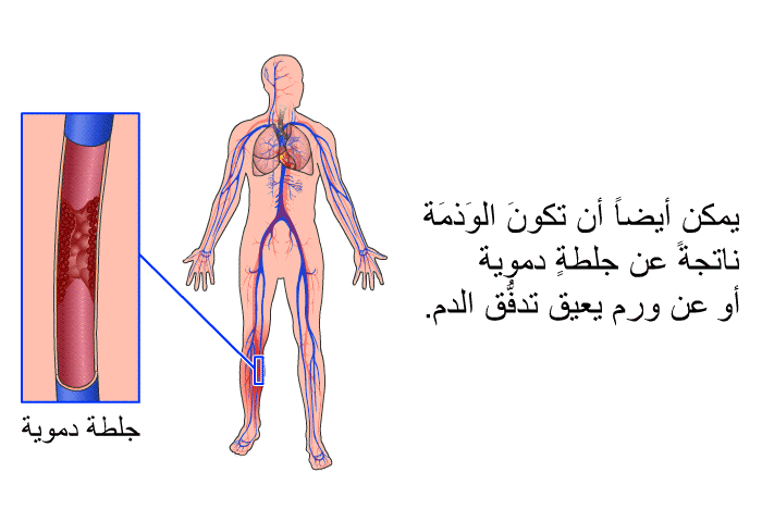يمكن أيضاً أن تكونَ الوَذمَة ناتجةً عن جلطةٍ دموية أو عن ورم يعيق تدفُّق الدم.