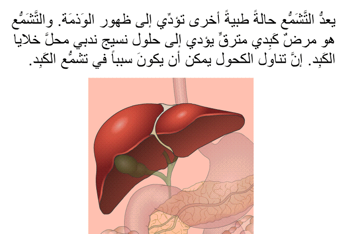 يعدُّ التَّشَمُّع حالةً طبيةً أخرى تؤدِّي إلى ظهور الوَذمَة. والتَّشَمُّع هو مرضٌ كَبِدي مترقٍّ يؤدي إلى حلول نسيج ندبي محلَّ خلايا الكَبِد. إنَّ تناول الكحول يمكن أن يكونَ سبباً في تشمُّع الكَبِد.