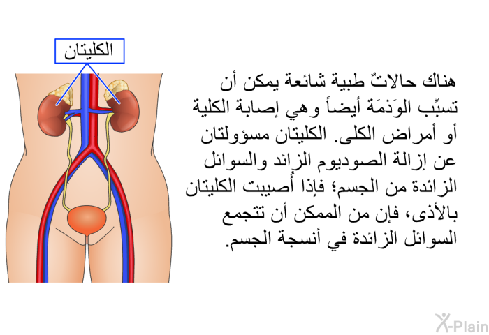 هناك حالاتٌ طبية شائعة يمكن أن تسبِّب الوَذمَة أيضاً، وهي إصابة الكلية أو أمراض الكلى. الكليتان مسؤولتان عن إزالة الصوديوم الزائد والسوائل الزائدة من الجسم؛ فإذا أُصيبت الكليتان بالأذى، فإن من الممكن أن تتجمع السوائل الزائدة في أنسجة الجسم.