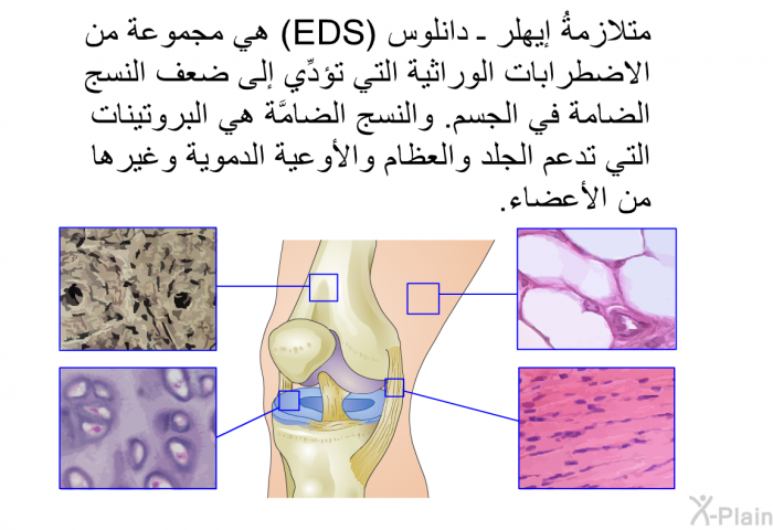 متلازمةُ إيهلر ـ دانلوس (EDS) هي مجموعة من الاضطرابات الوراثية التي تؤدِّي إلى ضعف النسج الضامة في الجسم. والنسج الضامَّة هي البروتينات التي تدعم الجلد والعظام والأوعية الدموية وغيرها من الأعضاء.