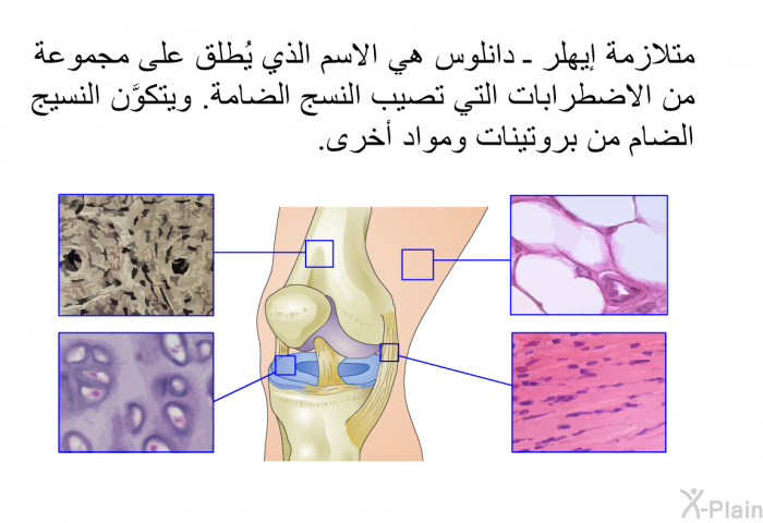 متلازمة إيهلر ـ دانلوس هي الاسم الذي يُطلق على مجموعة من الاضطرابات التي تصيب النسج الضامة. ويتكوَّن النسيج الضام من بروتينات ومواد أخرى.