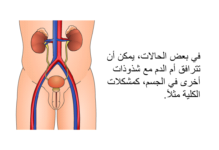 في بعض الحالات، يمكن أن تترافق أم الدم مع شذوذات أخرى في الجسم، كمشكلات الكلية مثلاً.