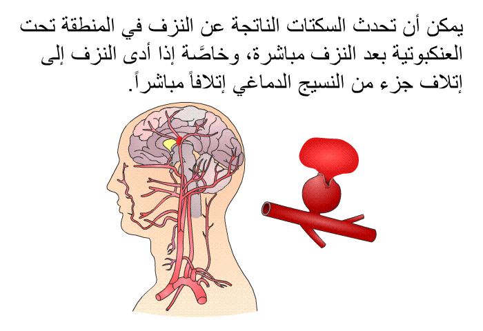 يمكن أن تحدث السكتات الناتجة عن النزف في المنطقة تحت العنكبوتية بعد النزف مباشرة، وخاصَّة إذا أدى النزف إلى إتلاف جزء من النسيج الدماغي إتلافاً مباشراً.