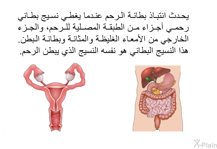 يحدث انتباذ بطانة الرحم عندما يغطي نسيج بطاني رحمي أجزاء من الطبقة المصلية للرحم، والجزء الخارجي من الأمعاء الغليظة والمثانة وبطانة البطن. هذا النسيج البطاني هو نفسه النسيج الذي يبطن الرحم.