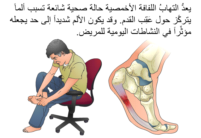 يعدُّ التهابُ اللفافة الأخمصية حالة صحية شائعة تسبب ألماً يتركَّز حول عَقِب القدم. وقد يكون الألم شديداً إلى حد يجعله مؤثِّراً في النشاطات اليومية للمريض.