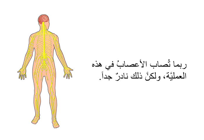 ربما تُصاب الأعصابُ في هذه العمليَّة، ولكنَّ ذلك نادرٌ جداً.