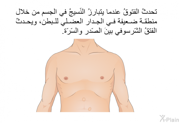 تحدثُ الفتوقُ عندما يتبارزُ النّسيجُ في الجسم من خلال منطقة ضعيفة في الجدار العضلي للبطن، ويحدثُ الفتقُ الشّرسوفي بينَ الصّدر والسّرّة.