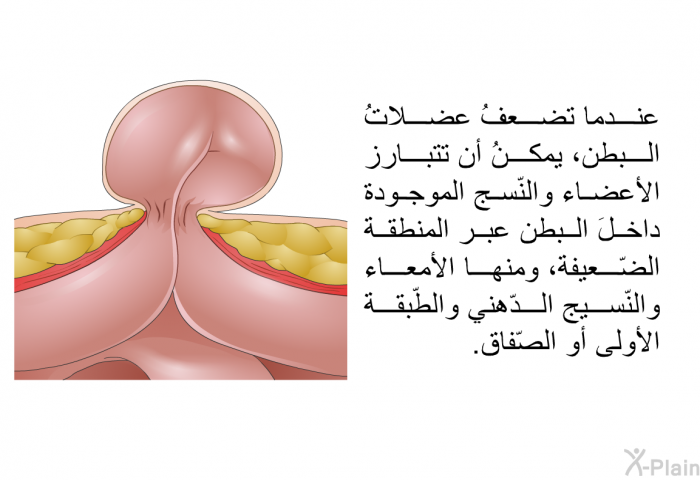 عندما تضعفُ عضلاتُ البطن، يمكنُ أن تتبارز الأعضاء والنّسج الموجودة داخلَ البطن عبر المنطقة الضّعيفة، ومنها الأمعاء والنّسيج الدّهني والطّبقة الأولى أو الصّفاق.