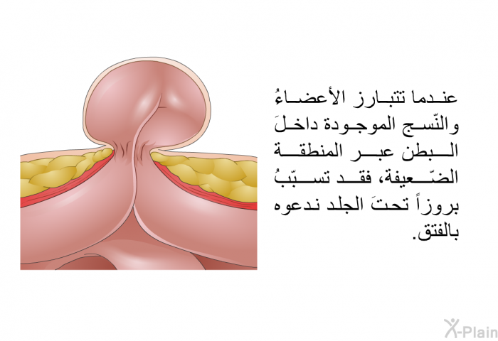 عندما تتبارز الأعضاءُ والنّسج الموجودة داخلَ البطن عبر المنطقة الضّعيفة، فقد تسبّبُ بروزاً تحتَ الجلد ندعوه بالفتق.